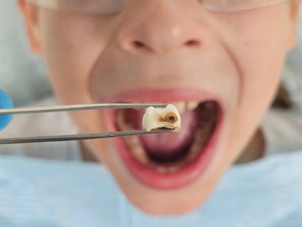 Best Root Canal Emergency Dentist  in Dunnavant, AL